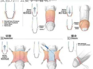 男人割了皮包什么样子要手举着呢 男人割了皮包为什么要手举着呢？