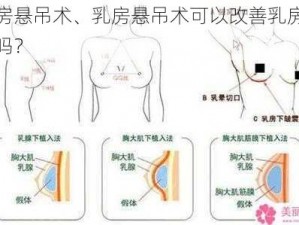 乳房悬吊术、乳房悬吊术可以改善乳房下垂吗？